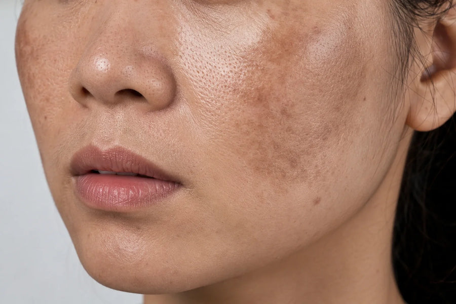 Sérum Facial Ácido Tranexâmico Anti-Manchas